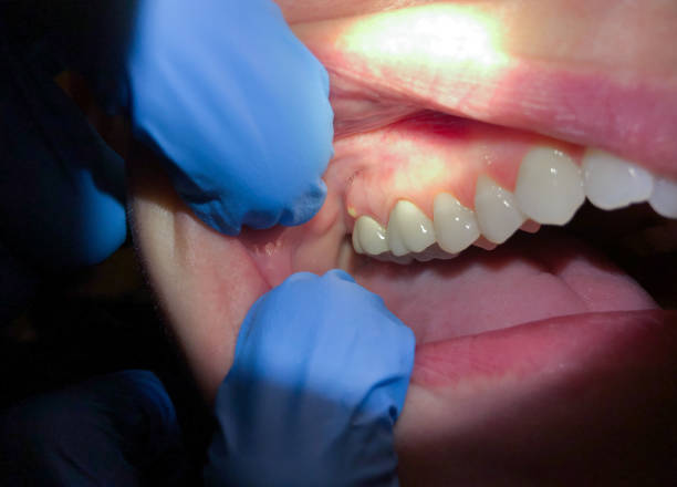 Best Emergency Dental Extractions in Belleville, PA